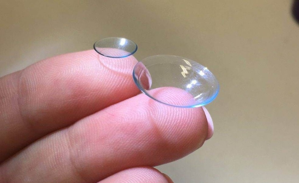 A Clearer Vision: Scleral Lenses as a Non-Surgical Solution for Corneal Scarring