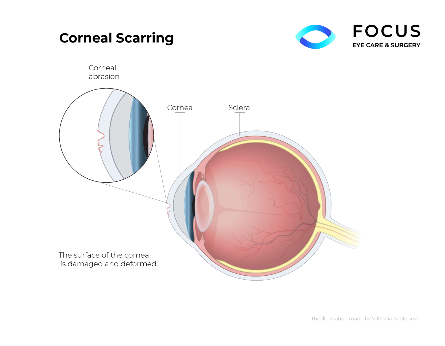 A corneal scar is either an opacity or irregularity that reduces the ability of the cornea to properly focus the light rays necessary to visualize any object. (Source: https://focuseye.io/condition/corneal-scarring/)