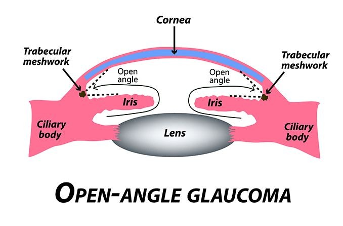 Slow-developing eye disease with high eye pressure that damages the optic nerve and causes vision loss. (Source: https://www.linkedin.com/pulse/glaucoma-silent-threat-vision-quality-life-lima-george/)