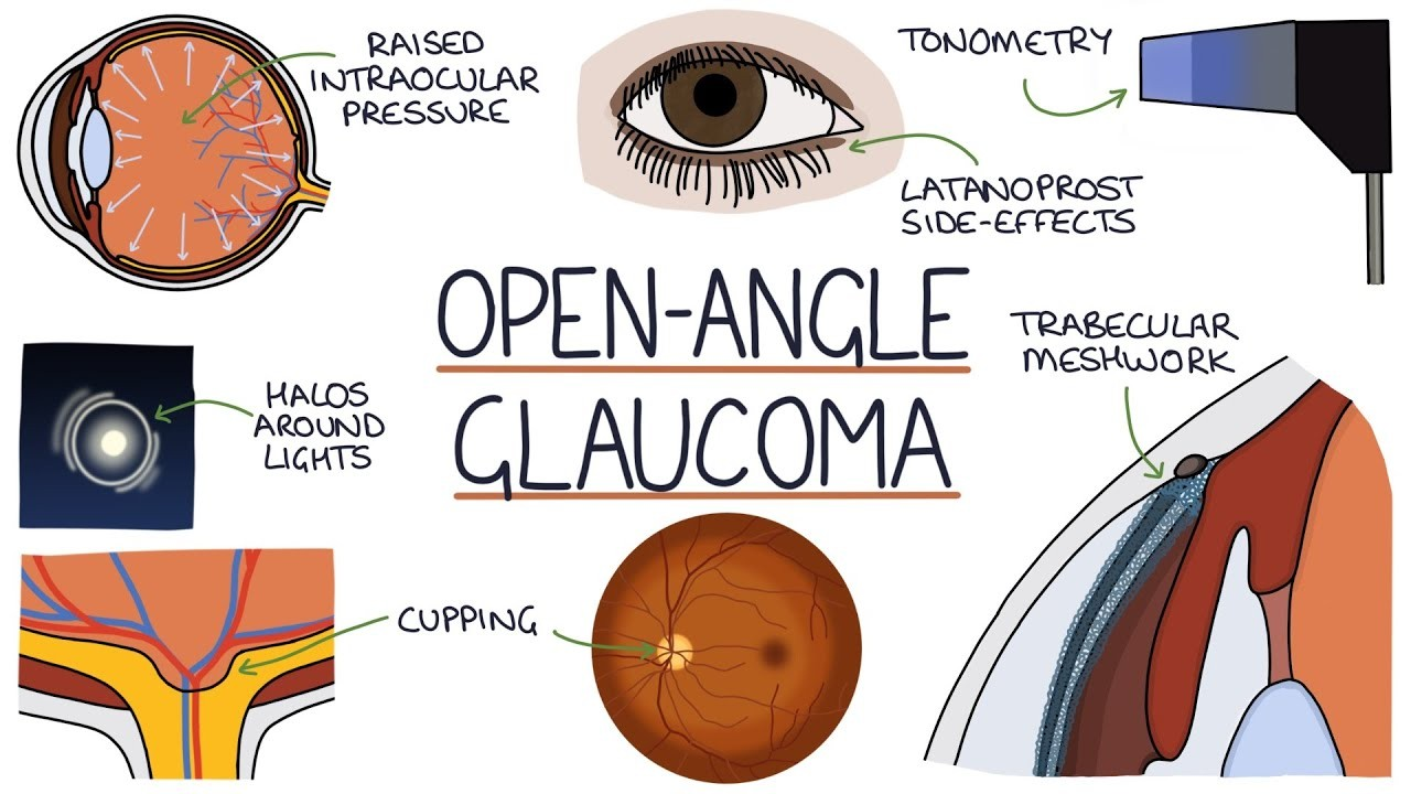 Slow-developing type of glaucoma where drainage angle remains open, but fluid doesn't drain properly, leading to optic nerve damage. (Source: https://www.linkedin.com/pulse/glaucoma-silent-threat-vision-quality-life-lima-george/)