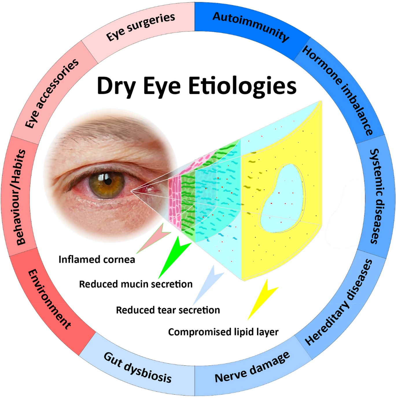 Schematic of dysregulated tear film during DES and the various intrinsic (blue background) and extrinsic (red background) etiologies (Source: https://link.springer.com/article/10.1007/s10792-022-02320-7)