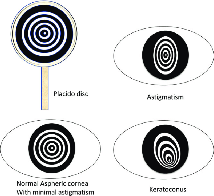 Placido disc and representative patterns of corneal shapes. (Source: https://www.researchgate.net/figure/Placido-disc-and-representative-patterns-of-corneal-shapes_fig1_321952298)