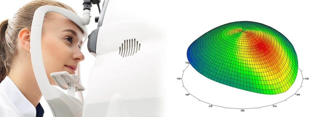 Keratoconus can cause corneal swelling and scarring, and even vision loss. (Source: https://www.optometrists.org/general-practice-optometry/guide-to-eye-conditions/guide-to-corneal-diseases/keratoconus/)