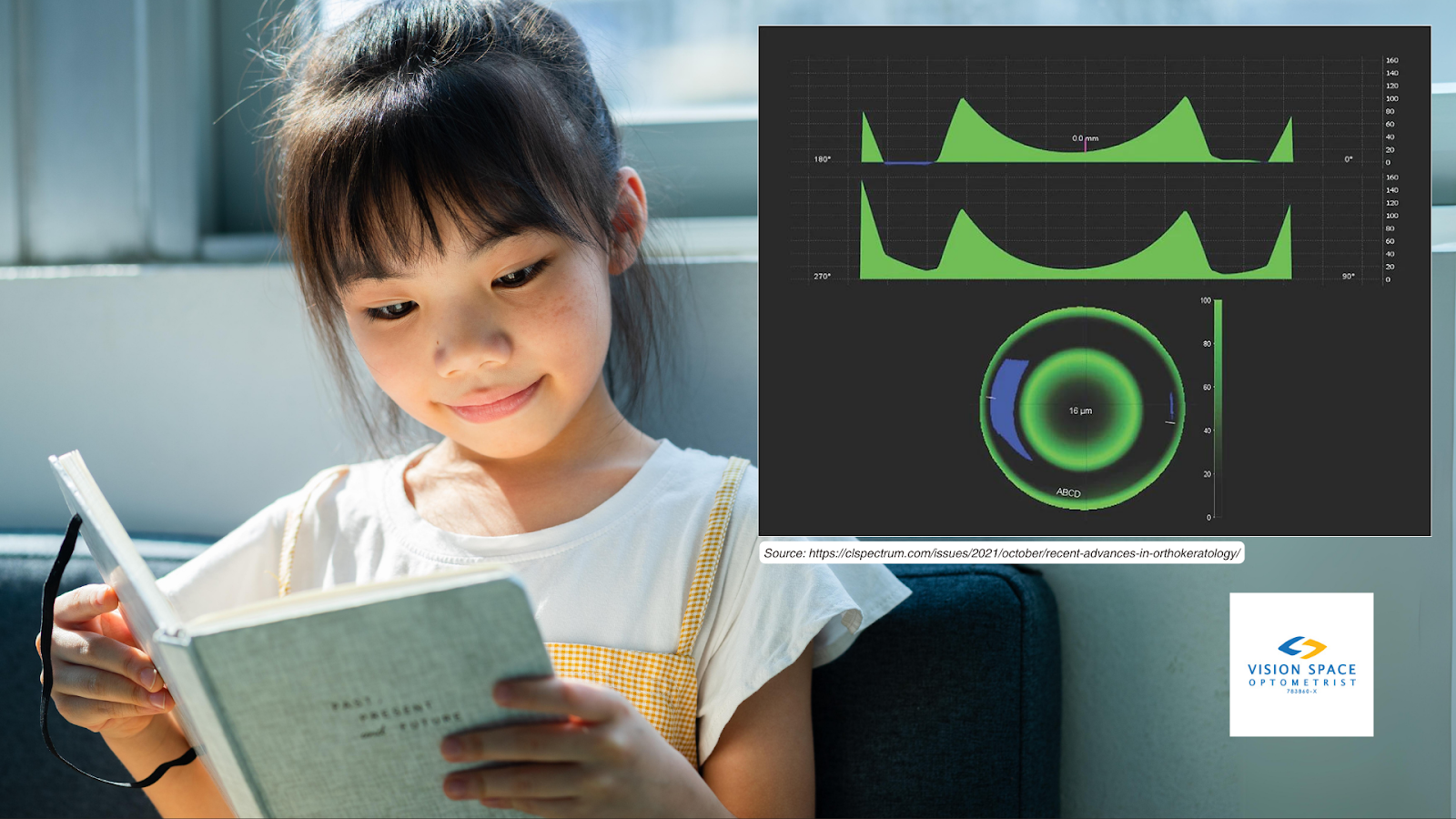 Ortho-k design software linked to corneal topography is also available when a high degree of customizability is desired. [Image Source: https://clspectrum.com/issues/2021/october/recent-advances-in-orthokeratology/.]