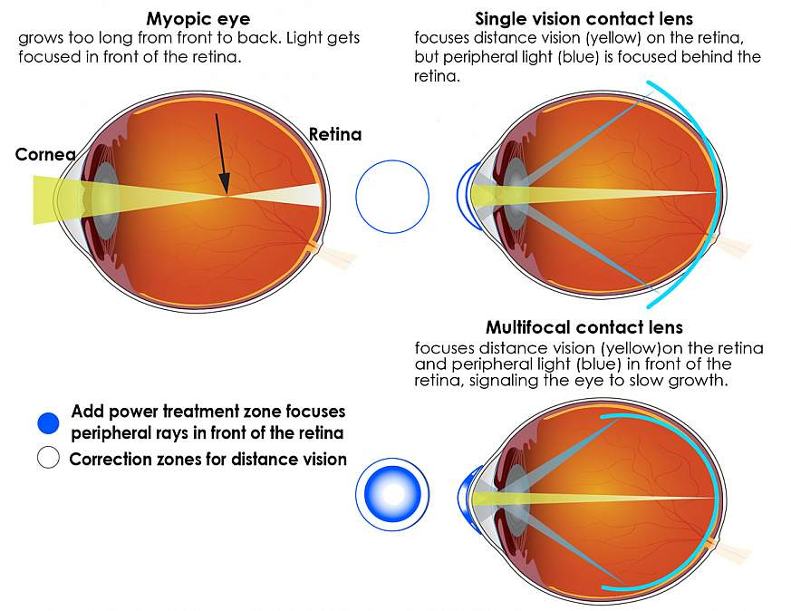 Children wearing multifocal contact lenses had slower progression of their myopia, according to results from a clinical trial funded by the National Eye Institute, part of the National Institutes of Health. (Source: https://www.nih.gov/news-events/news-releases/multifocal-contact-lenses-slow-myopia-progression-children)